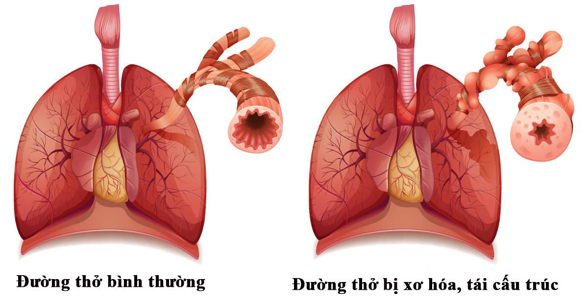 Tái cấu trúc đường thở là gì? Tại sao tái cấu trúc đường thở lại gây viêm phế quản, viêm phổi tái phát nhiều lần?